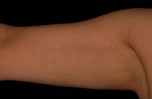 Female Upper arms after 